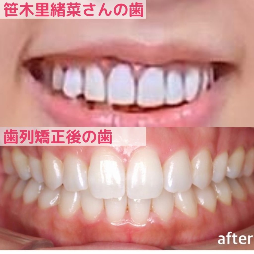 笹木里緒菜の歯と歯列矯正後の歯を比較