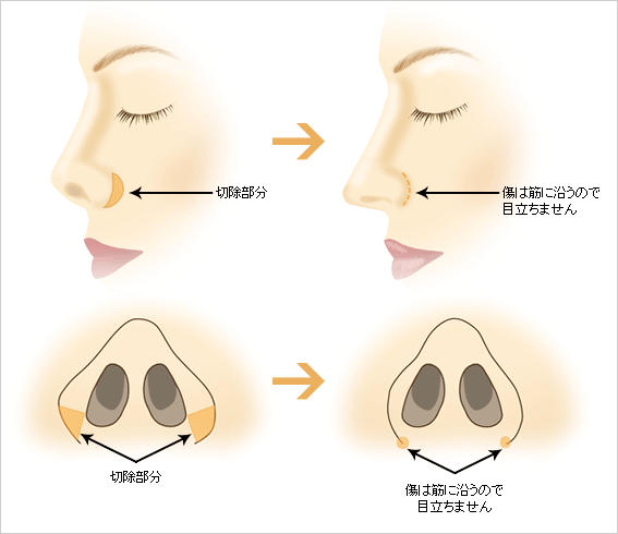 小鼻切開とは
