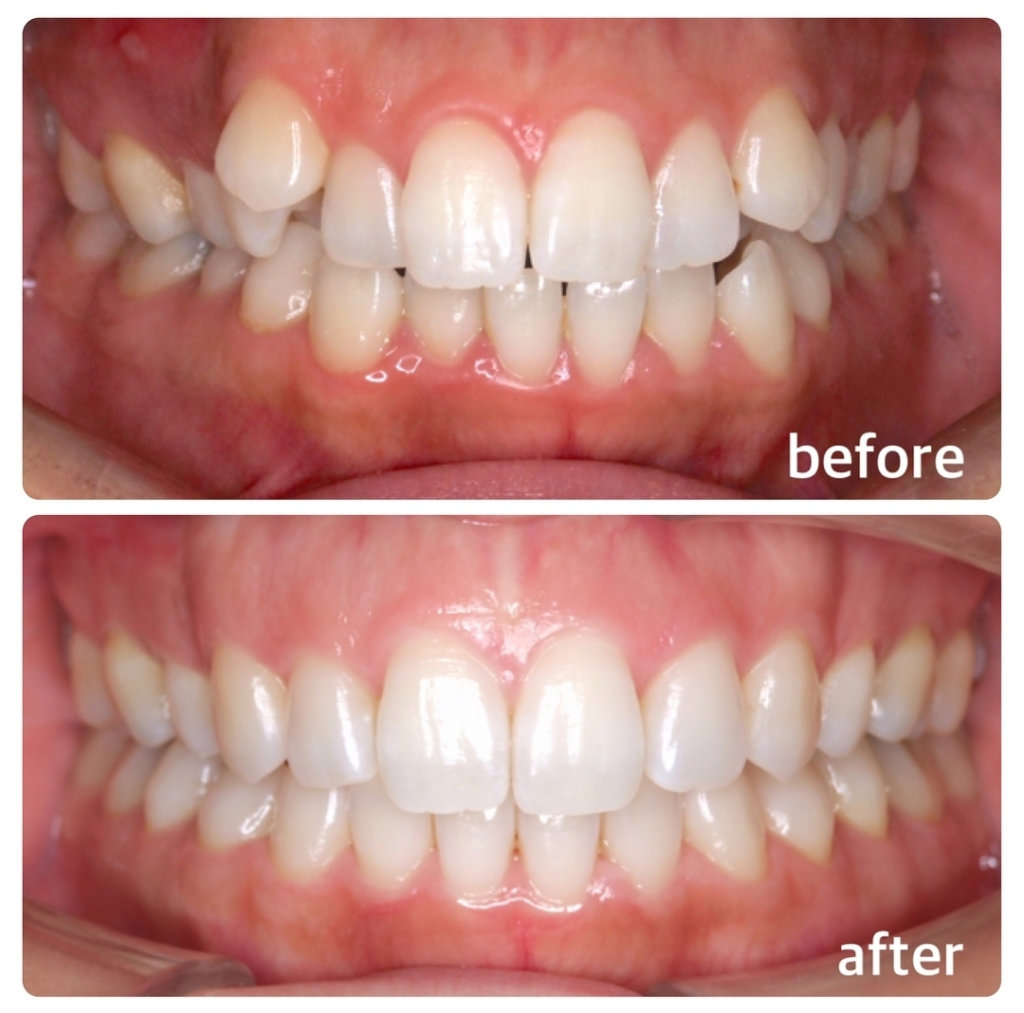 歯列矯正後の歯並び